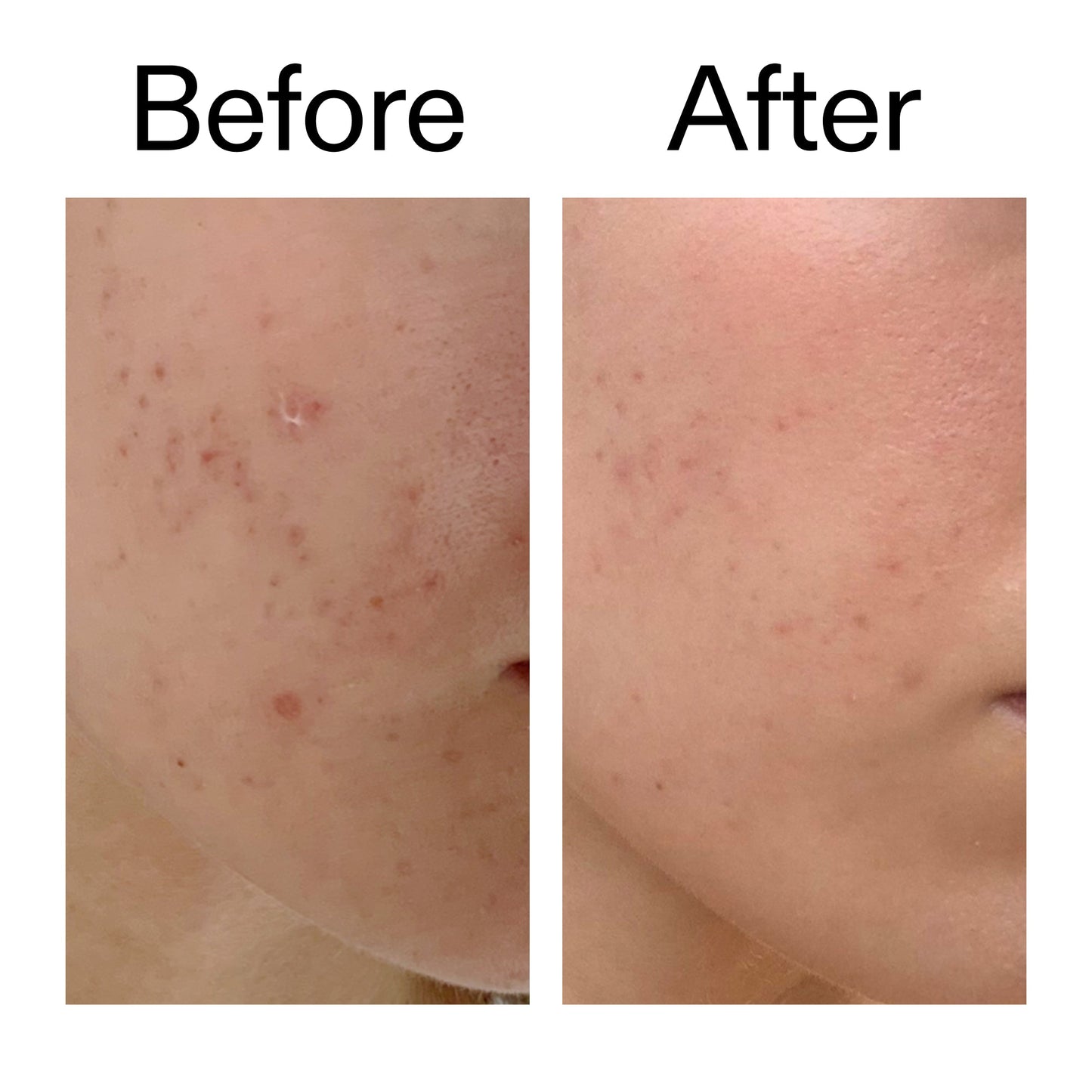 mandelic-acid-treatment-n8 Mandelic_Acid_Treatment_Before_After_2000x2000_4885ac6e-c5d7-4279-a72a-1417af7dce35.jpg