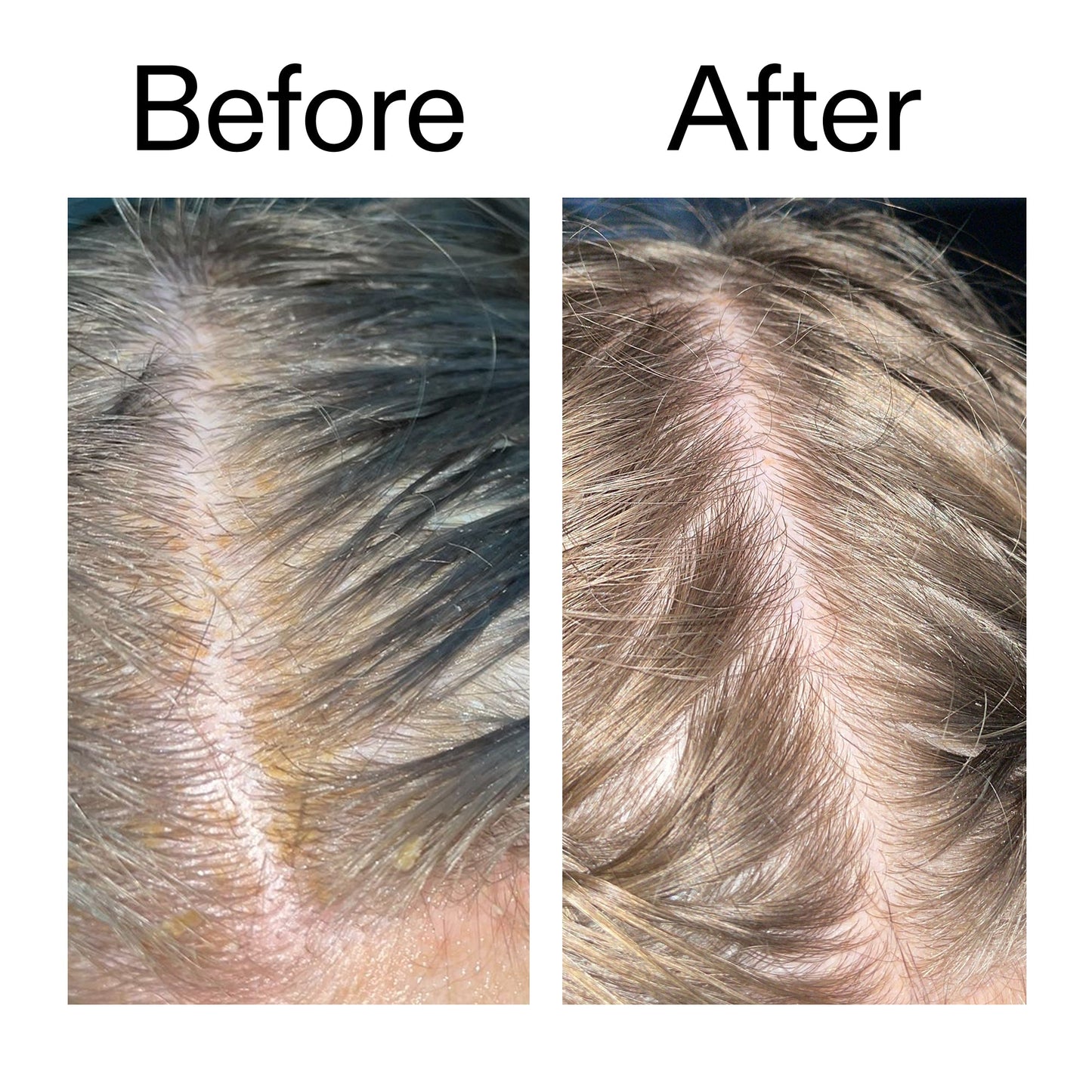 salicylic-acid-exfoliating-scalp-treatment-s9 Salicylic_Acid_Exfoliating_Scalp_Treatment_Before_After_2000x2000_e572a30f-057c-4a48-823b-1c09dc97f8d0.jpg