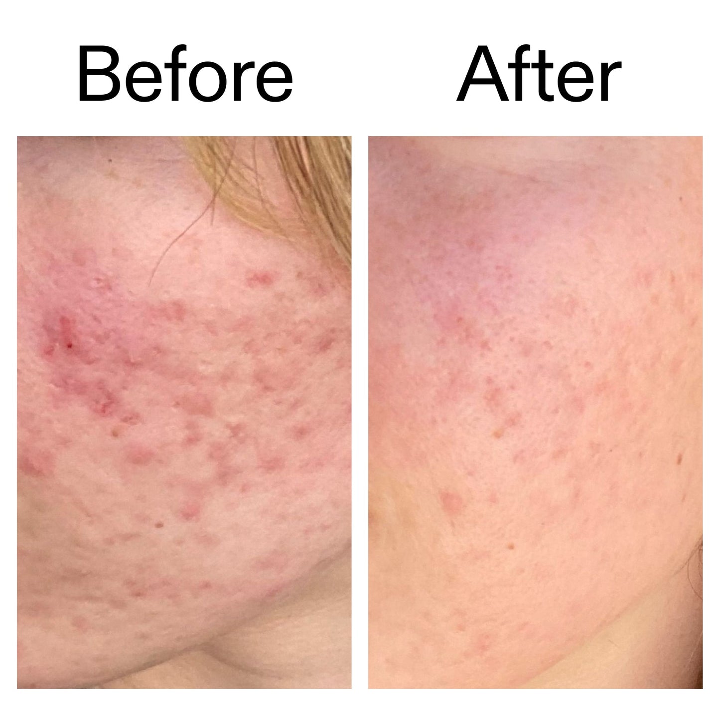 10-azelaic-acid-serum-for-redness-relief-s9 Azealic_Acid_Serum_B_A_Ppage_2000_x_2000.jpg