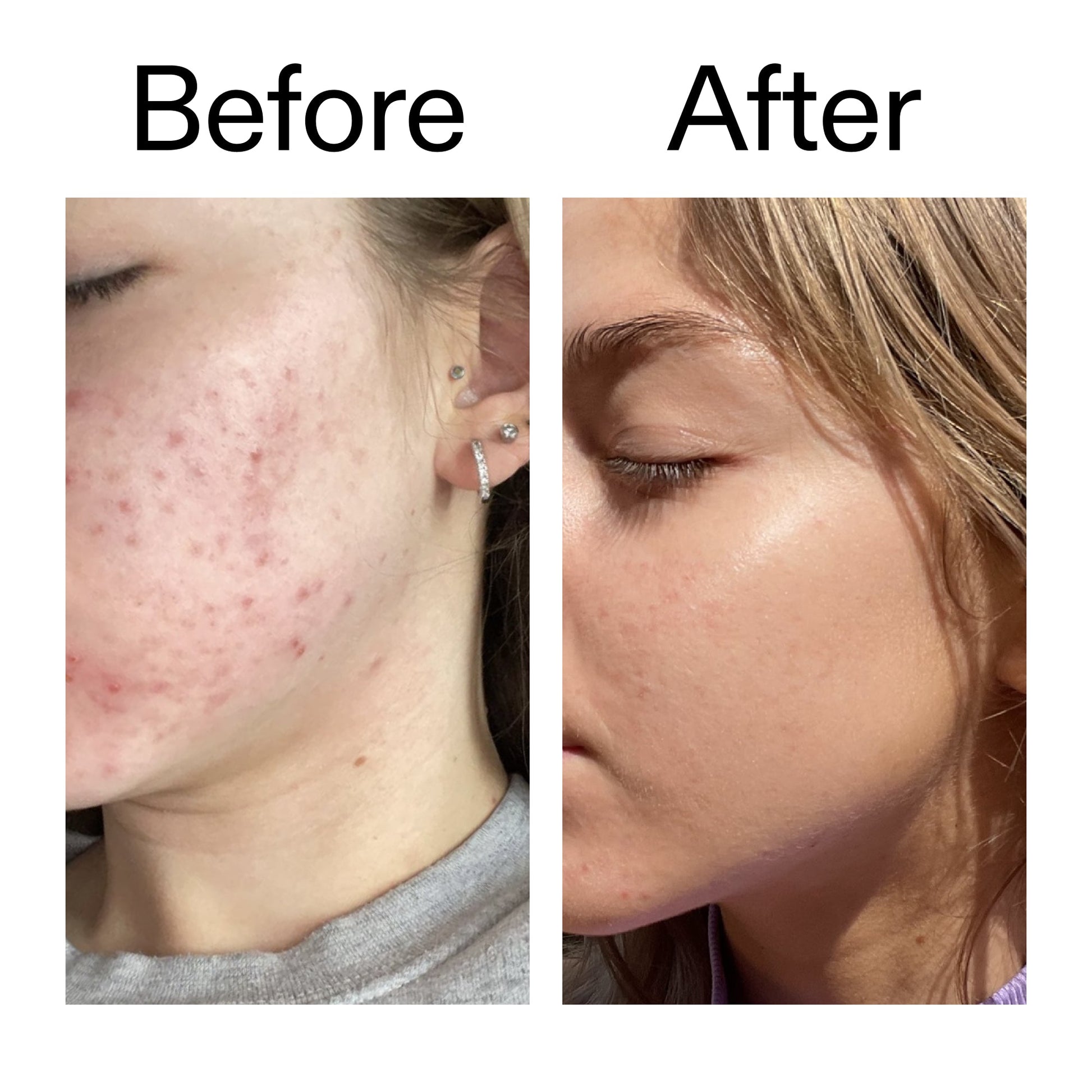 beta-hydroxy-acid-bha-serum-l0 Beta_Hydroxy_Acid_Serum_Before_After_2000x2000_96fda3e5-938d-49ef-bcf2-a0fa6ece4e2c.jpg