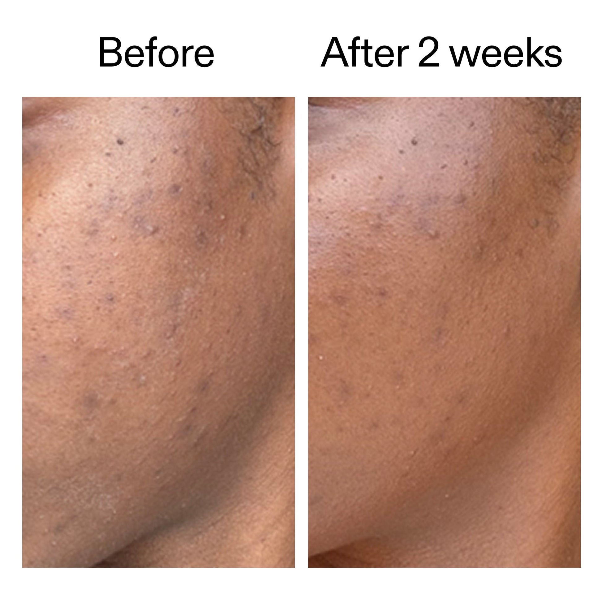 360-acne-clearing-serum-f5 DIOICB_A2000x2000.jpg