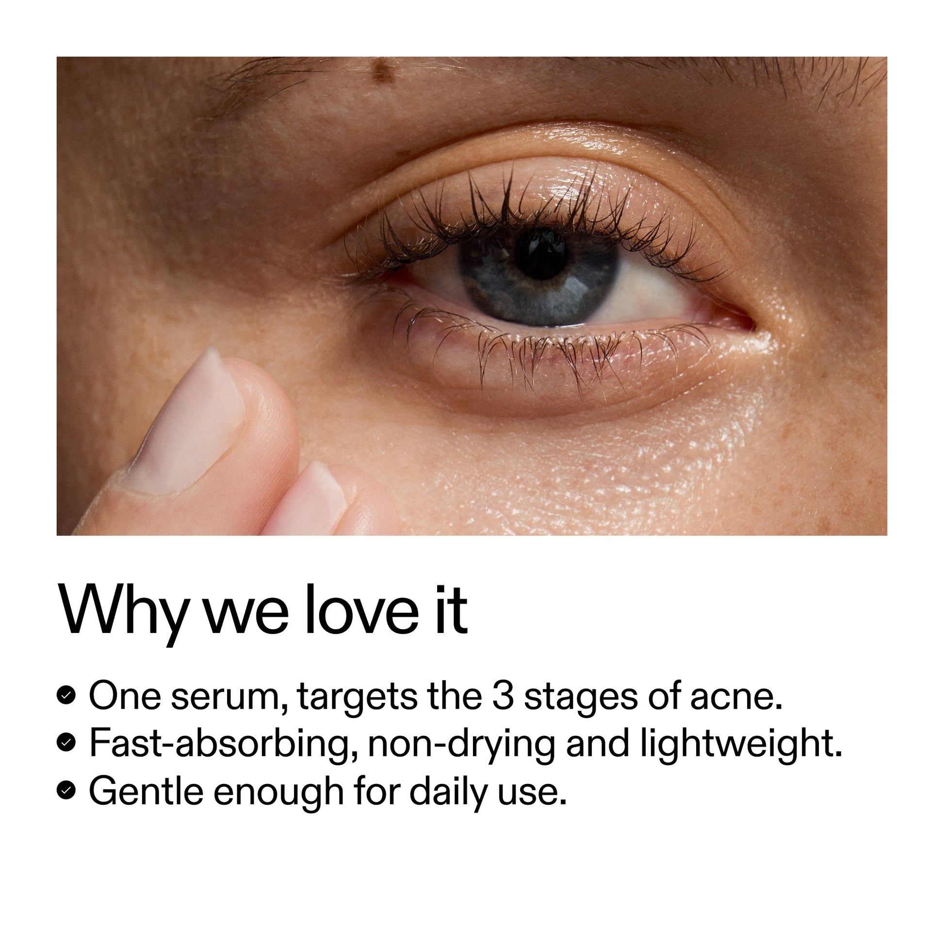 360-acne-clearing-serum-f5 Dioic_Whyweloveit_2000x2000_175aafd3-0cbe-403a-b317-a8362881bfe2.jpg