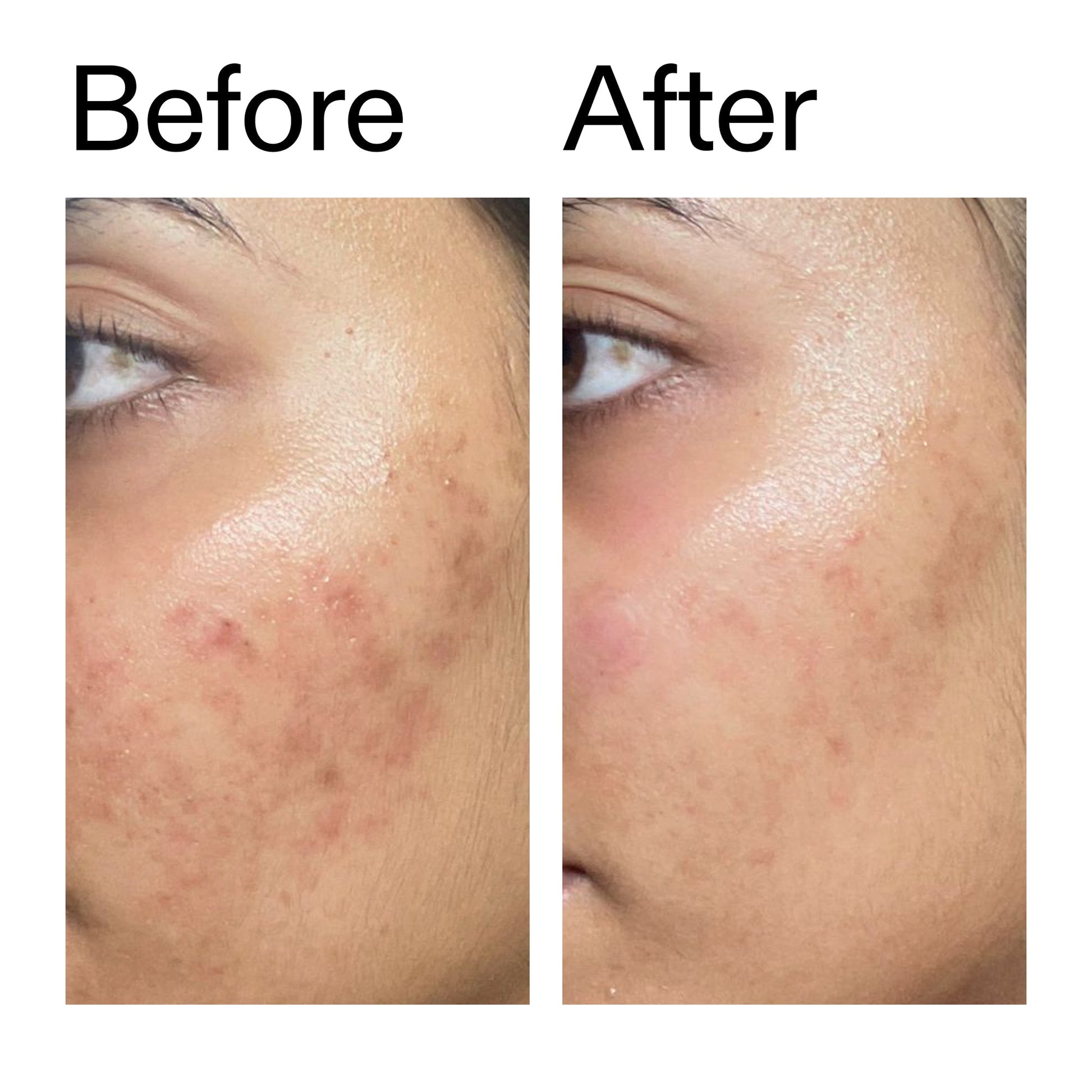 ectoin-hydro-barrier-serum-duo-e7 Ectoin_Hydro-barrier_Serum__Before_After_2000x2000_34261920-d004-48d0-9c7b-8e1c15971bfd.jpg