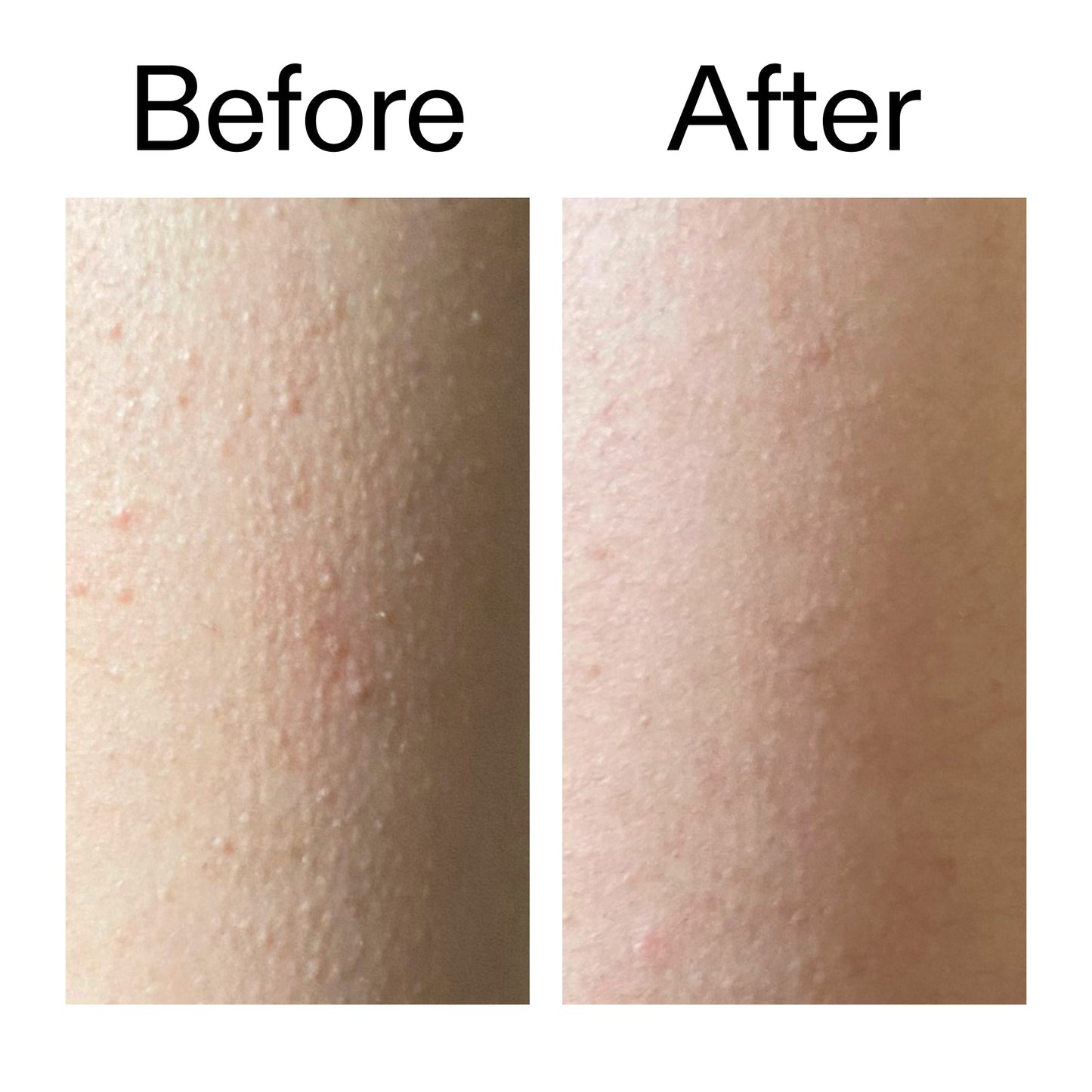 glycolic-acid-exfoliating-body-stick-v6 Glycolic_Acid_Exfoliating_Body_Stick_Before_After_V2_2000x2000_2e4ba052-94f6-4d56-82df-7bdb5b2df7ae.jpg