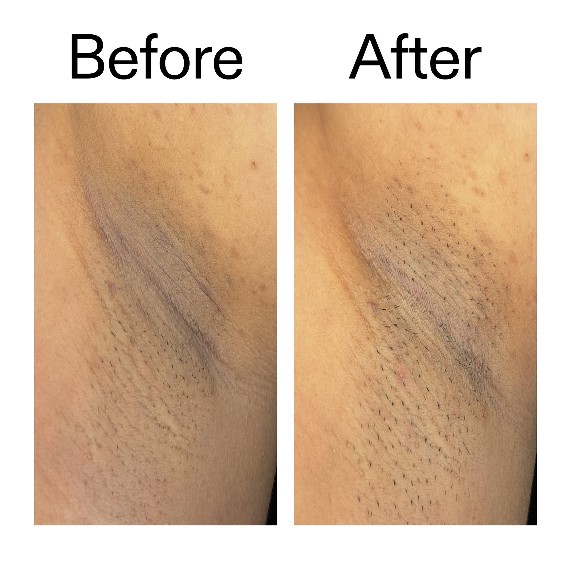 glycolic-acid-exfoliating-body-stick-v6 Glycolic_Acid_Exfoliating_Body_Stick_Before_After_V3_2000x2000_ea919cd9-1439-4a46-82a0-76200eb5bb42.jpg