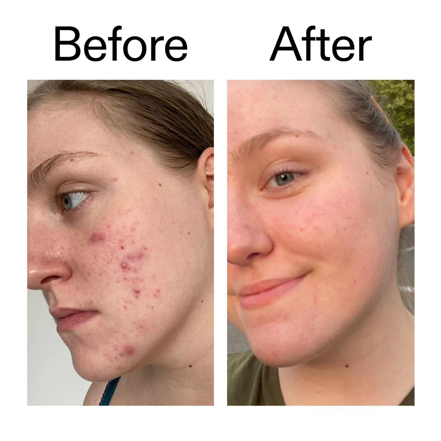 glycolic-acid-toner-h7 Glycolic_Acid_Toner_Before_After_2000x2000_49f0b9f7-e71b-4b2e-a8f8-2ea4b73247bb.jpg