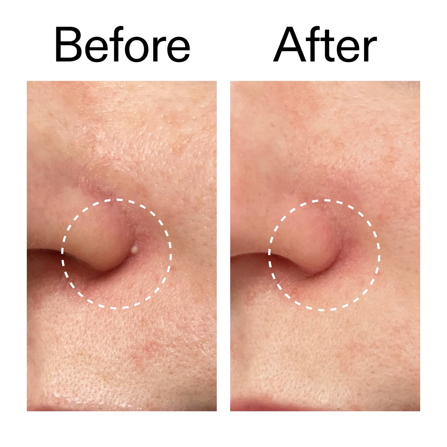hydrocolloid-invisible-pimple-patches-pack-of-22-p1 Hydrocolloid_Invisible_Pimple_Patches_Before_After_2000x2000_b02aa37b-c78a-4682-91de-9135af5bb7df.jpg