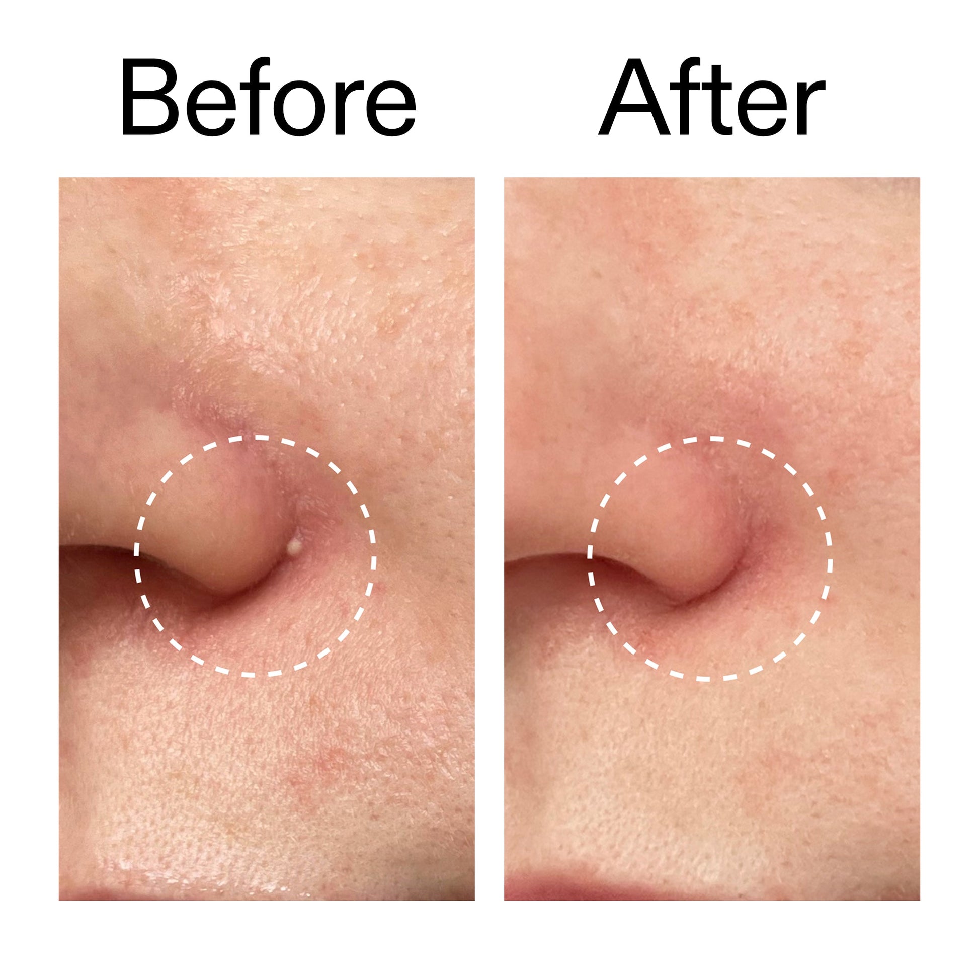 hydrocolloid-invisible-pimple-patches-pack-of-22-p1 Hydrocolloid_Invisible_Pimple_Patches_Before_After_2000x2000_b02aa37b-c78a-4682-91de-9135af5bb7df.jpg
