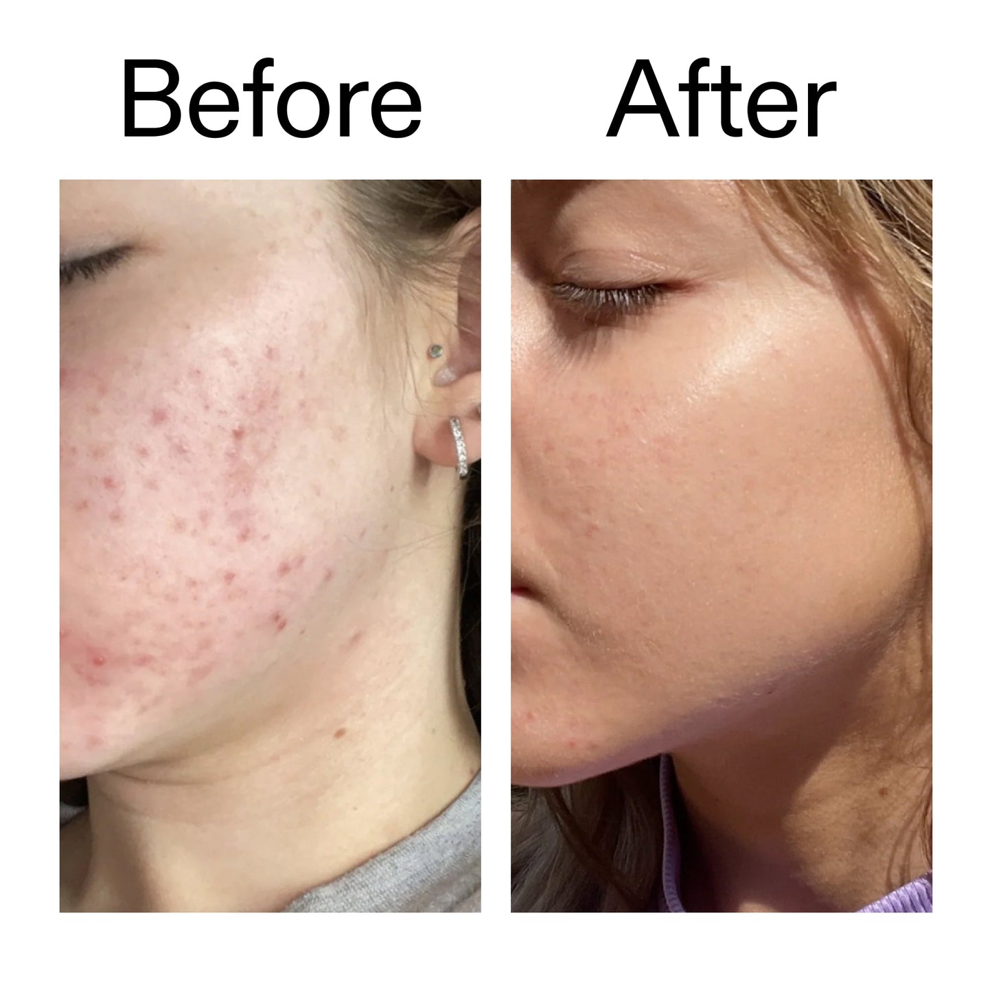 10-niacinamide-serum-q8 Niacinamide_Serum_Before_After_2000x2000_bde32455-9e7d-448e-b053-bef41504f0a9.jpg