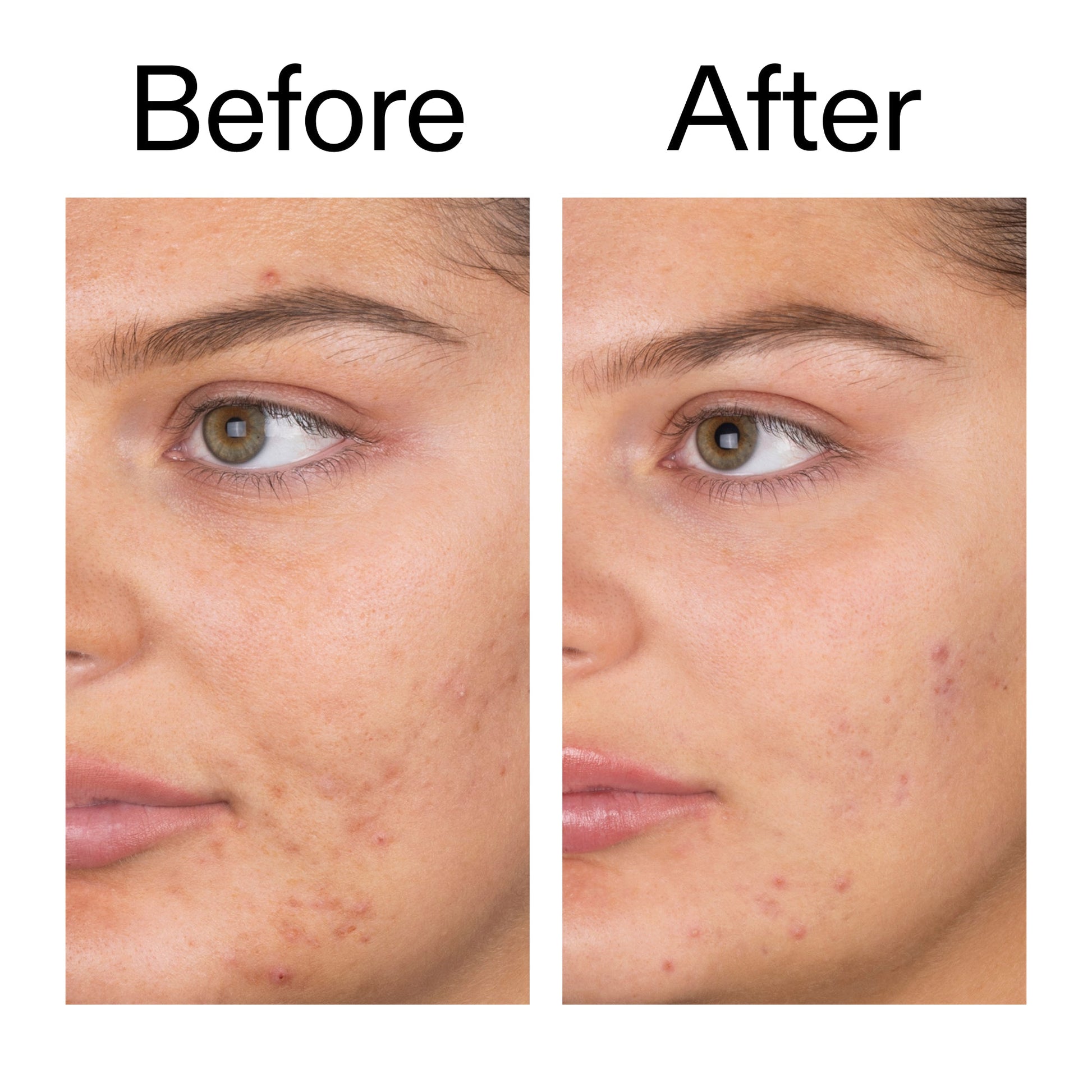 salicylic-acid-cleanser-150ml-a0 Salicylic_Acid_Cleanser_-_150ml_Before_After_2000x2000_e7230494-853f-4b07-82b1-27669104c995.jpg