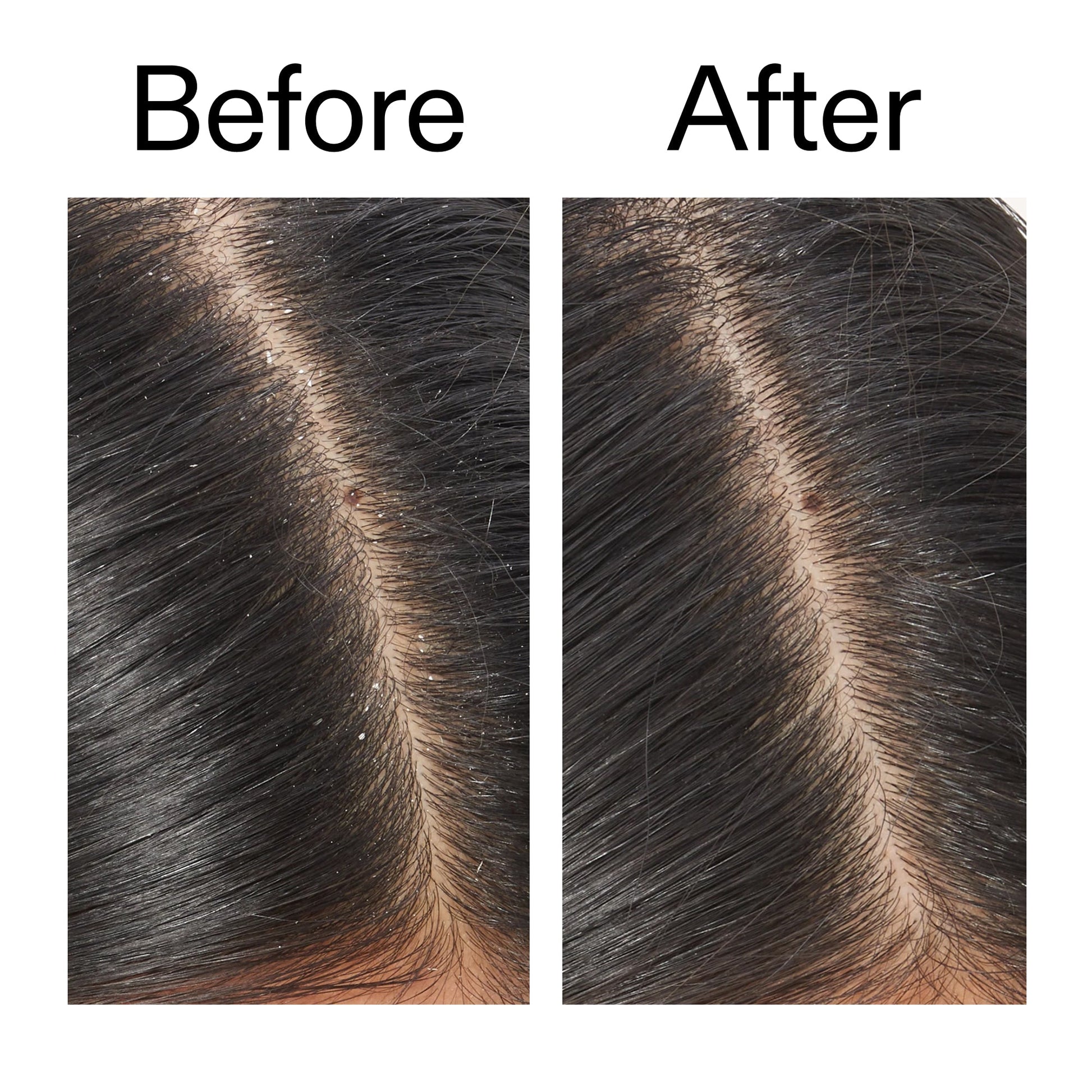 salicylic-acid-exfoliating-scalp-treatment-s9 Salicylic_Acid_Exfoliating_Scalp_Treatment_Before_After_V2_2000x2000_02bd61ad-42bf-490b-b3e3-7e04b2e8a673.jpg
