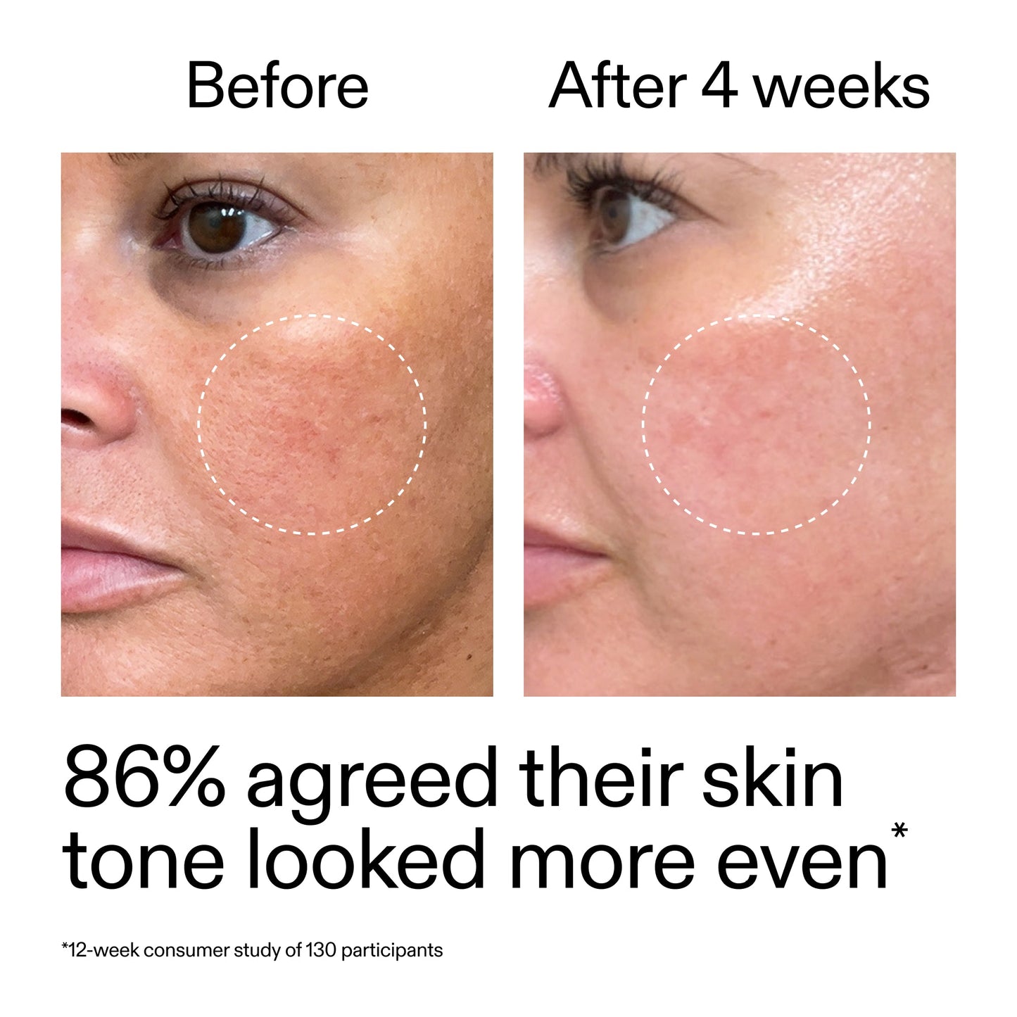 starter-retinol-serum-m4 StarterRetinol_BeforeAfter_Claim2_2000x2000_f5c9ecc0-8d76-429d-bef5-c3a61bcf5c09.jpg