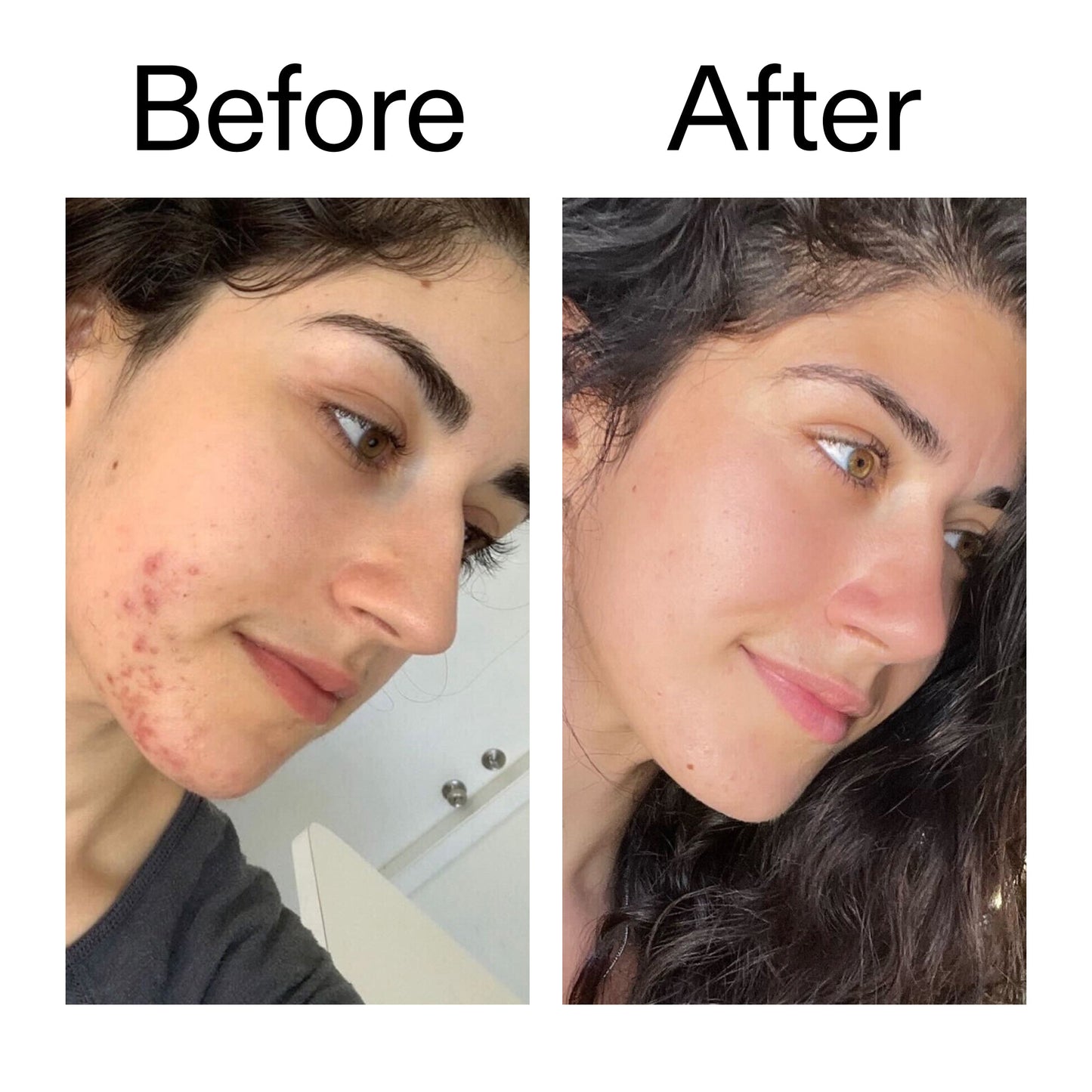 succinic-acid-acne-treatment-a9 Succinic_Acid_Treatment_Before_After_2000x2000_6a5f0054-2f58-4433-9314-0dc72c9bdd3b.jpg