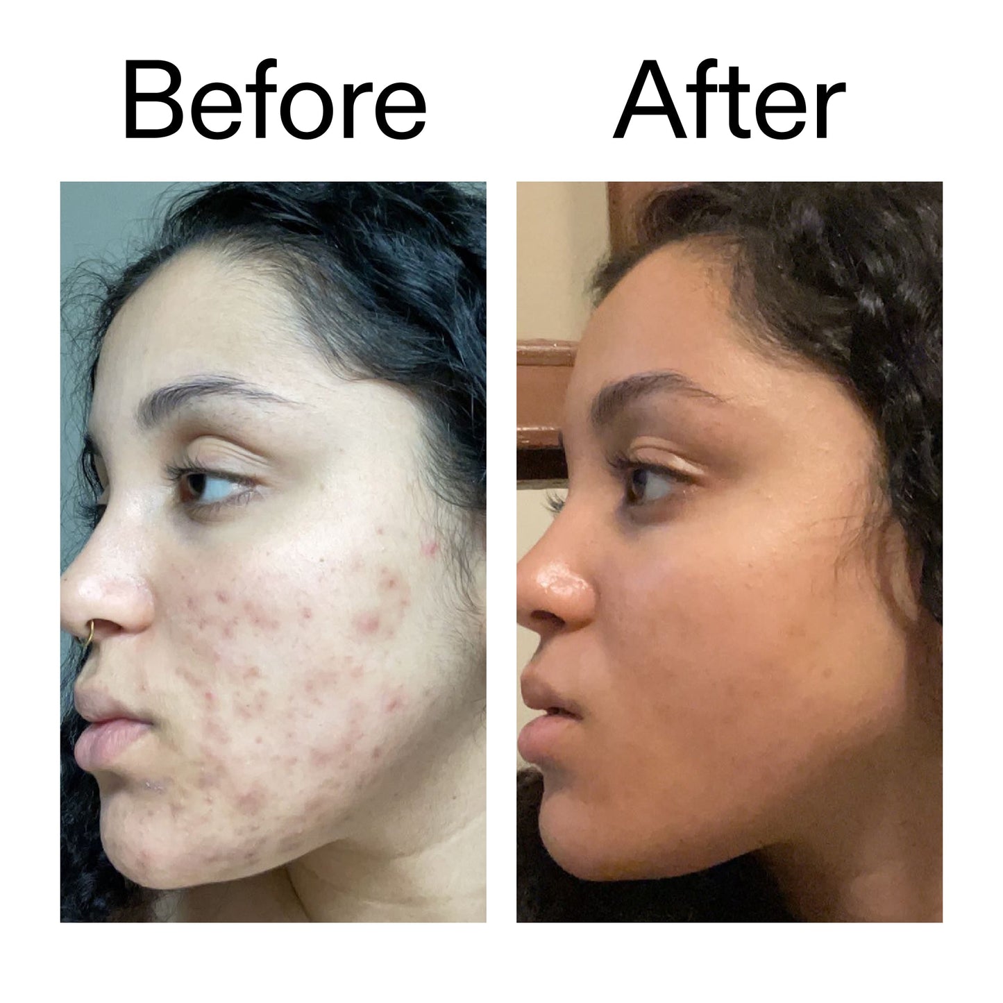 tranexamic-acid-serum-p4 Tranexamic_Acid_Serum_Before_After_2000x2000_98ebc8be-77b0-4843-8a22-90790ebe918b.jpg